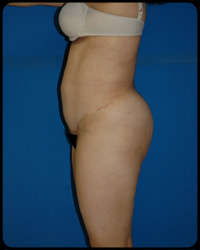 Abdominoplasty - Tummy Tuck 