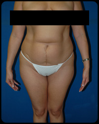 Abdominoplasty - Tummy Tuck 