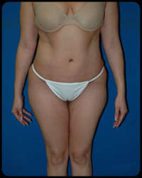 Abdominoplasty - Tummy Tuck 