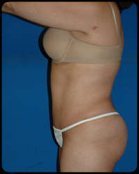 Abdominoplasty - Tummy Tuck 