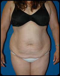 Abdominoplasty - Tummy Tuck 