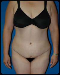 Abdominoplasty - Tummy Tuck 