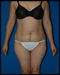 Abdominoplasty - Tummy Tuck 