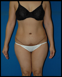 Abdominoplasty - Tummy Tuck 