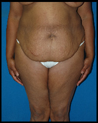 Abdominoplasty - Tummy Tuck 