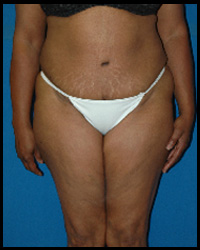 Abdominoplasty - Tummy Tuck 