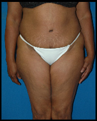 Abdominoplasty - Tummy Tuck 