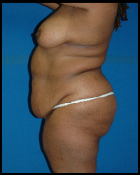 Abdominoplasty - Tummy Tuck 