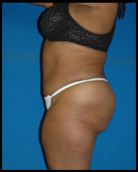 Abdominoplasty - Tummy Tuck 