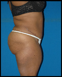 Abdominoplasty - Tummy Tuck 