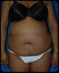 Abdominoplasty - Tummy Tuck 