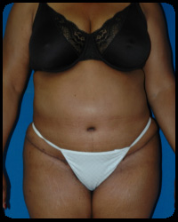 Abdominoplasty - Tummy Tuck 