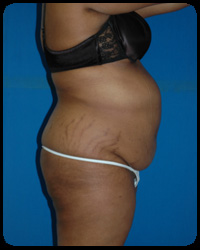 Abdominoplasty - Tummy Tuck 