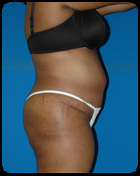 Abdominoplasty - Tummy Tuck 