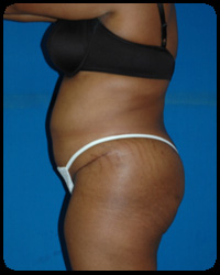 Abdominoplasty - Tummy Tuck 