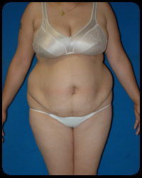 Abdominoplasty - Tummy Tuck 