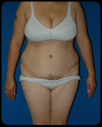 Abdominoplasty - Tummy Tuck 