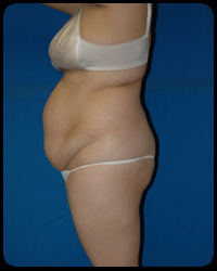 Abdominoplasty - Tummy Tuck 