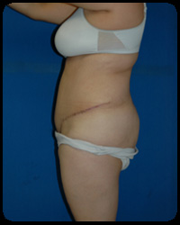 Abdominoplasty - Tummy Tuck 