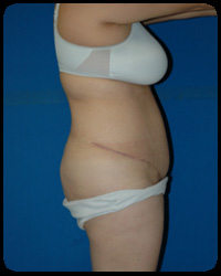 Abdominoplasty - Tummy Tuck 