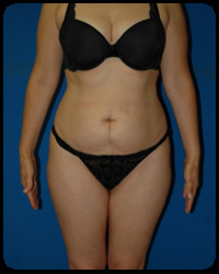 Abdominoplasty - Tummy Tuck 