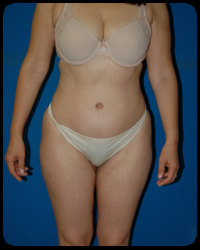 Abdominoplasty - Tummy Tuck 