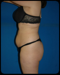 Abdominoplasty - Tummy Tuck 