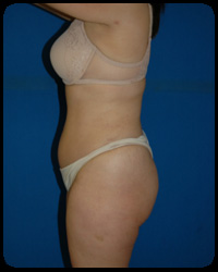 Abdominoplasty - Tummy Tuck 