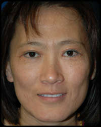 Eyelid Surgery - Blepharoplasty 