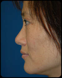 Eyelid Surgery - Blepharoplasty 