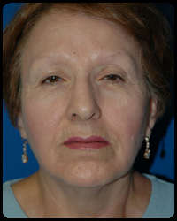 Eyelid Surgery - Blepharoplasty 