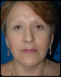 Eyelid Surgery - Blepharoplasty 