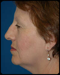 Eyelid Surgery - Blepharoplasty 