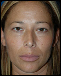 Eyelid Surgery - Blepharoplasty 