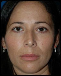 Eyelid Surgery - Blepharoplasty 