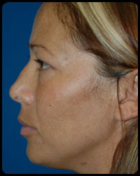 Eyelid Surgery - Blepharoplasty 