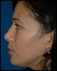 Eyelid Surgery - Blepharoplasty 