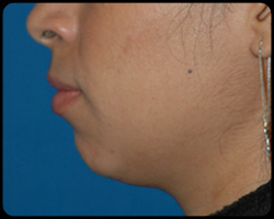 Chin Surgery - Genioplasty 