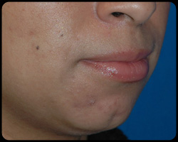 Chin Surgery - Genioplasty 