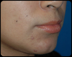 Chin Surgery - Genioplasty 