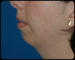 Chin Surgery - Genioplasty 