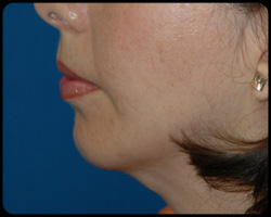 Chin Surgery - Genioplasty 