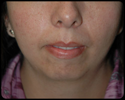 Chin Surgery - Genioplasty 