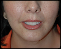 Chin Surgery - Genioplasty 