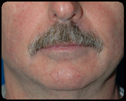 Chin Surgery - Genioplasty 