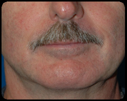 Chin Surgery - Genioplasty 