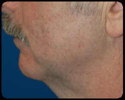 Chin Surgery - Genioplasty 