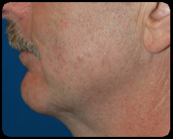 Chin Surgery - Genioplasty 