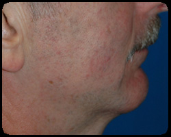 Chin Surgery - Genioplasty 