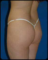 Gluteal Augmentation 